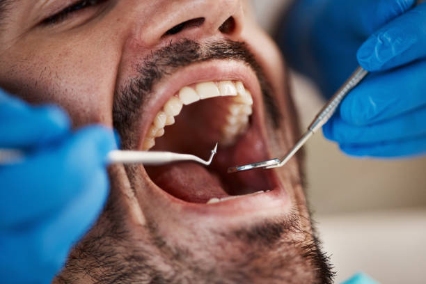 Best Emergency Wisdom Teeth Removal in Buena Vista, GA